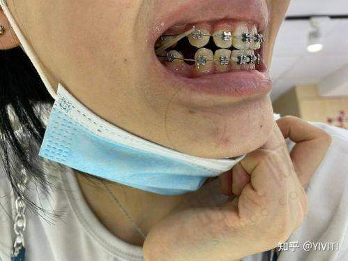 呼和浩特种牙后饮食怎么安排?1 - 7天“不耽误工作”食谱