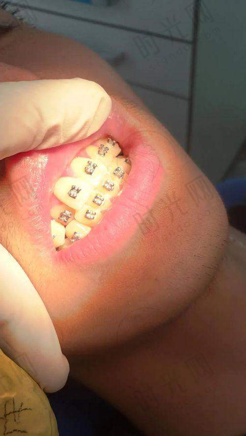 宁波鄞州德中口腔种牙的行动避坑指南