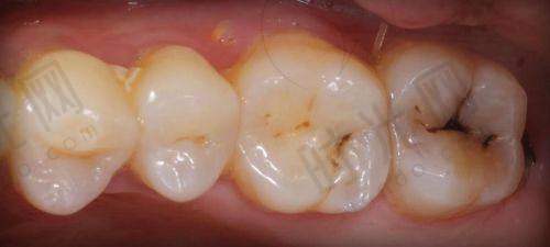 宁波鄞州德中口腔种牙收费标准的认知误区